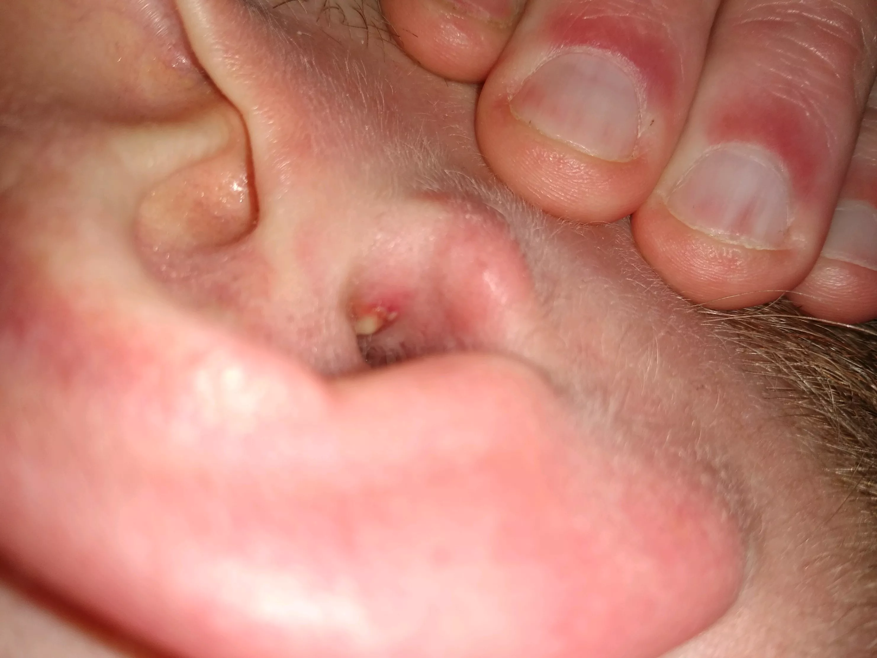 I scratched an itch in my ear with a piece of plastic and I woke up to this the next day. Multiple heads, small volcano when I popped it. Not sure about proper flair for this.