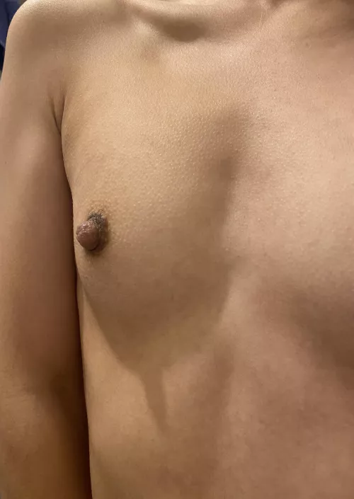 Tiny bumps all round