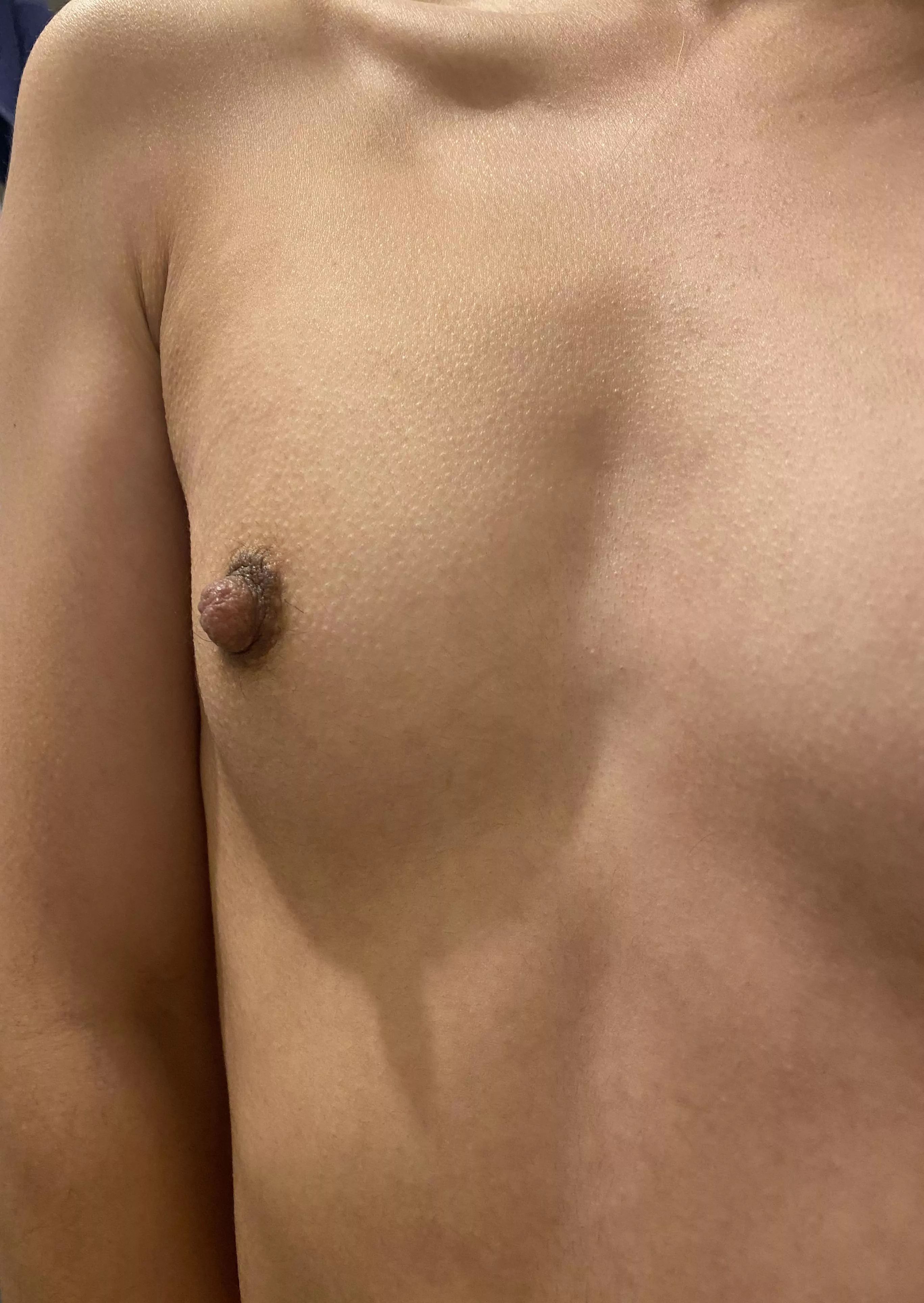 Tiny bumps all round