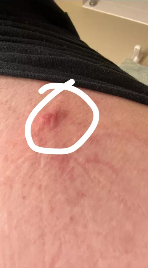 What is this? It’s almost like a pimple but I have had pimples here before and this one is different…