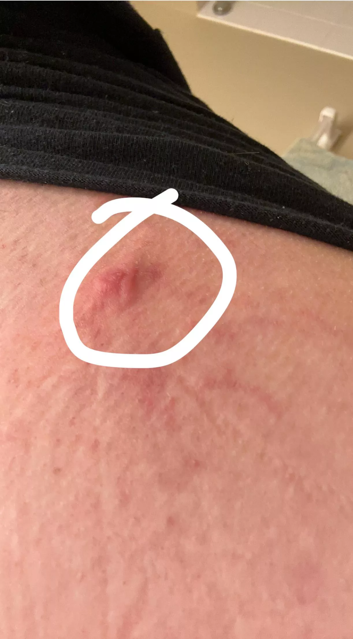 What is this? It’s almost like a pimple but I have had pimples here before and this one is different…
