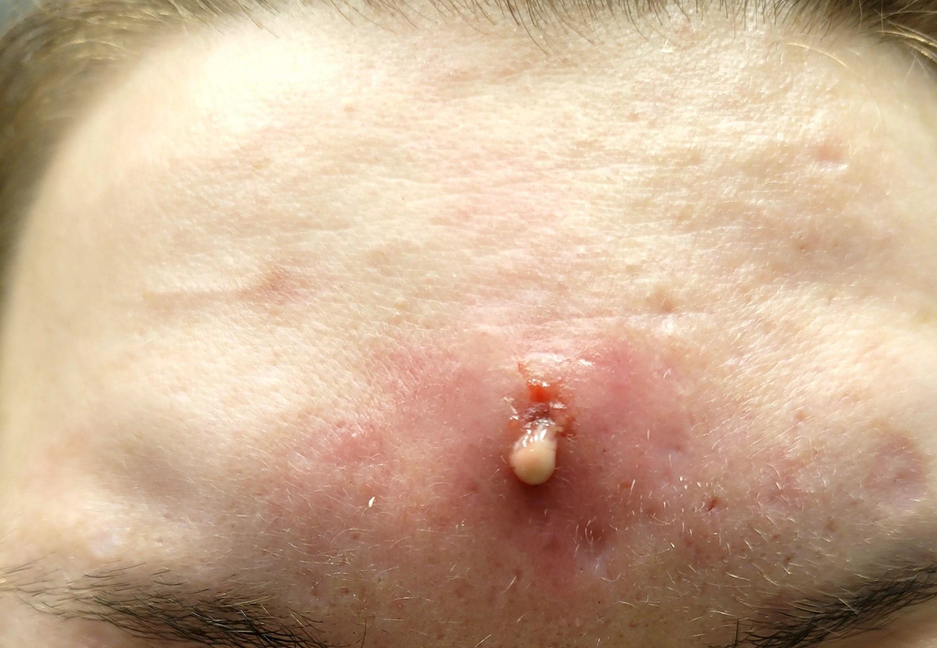 Aftermath from one of the most painful cystic pimples I've ever had. Immediate relief after 5 days of hell!