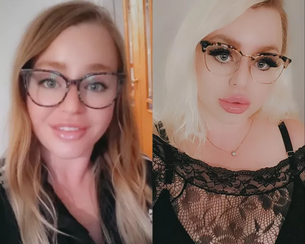 From my first time getting lip filler to now 💕