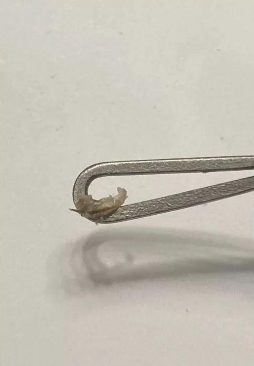 This came out of a REALLY painful bump in a stretch mark on my side. Maybe an ingrown? The whole thing was hard, so I’m not certain.