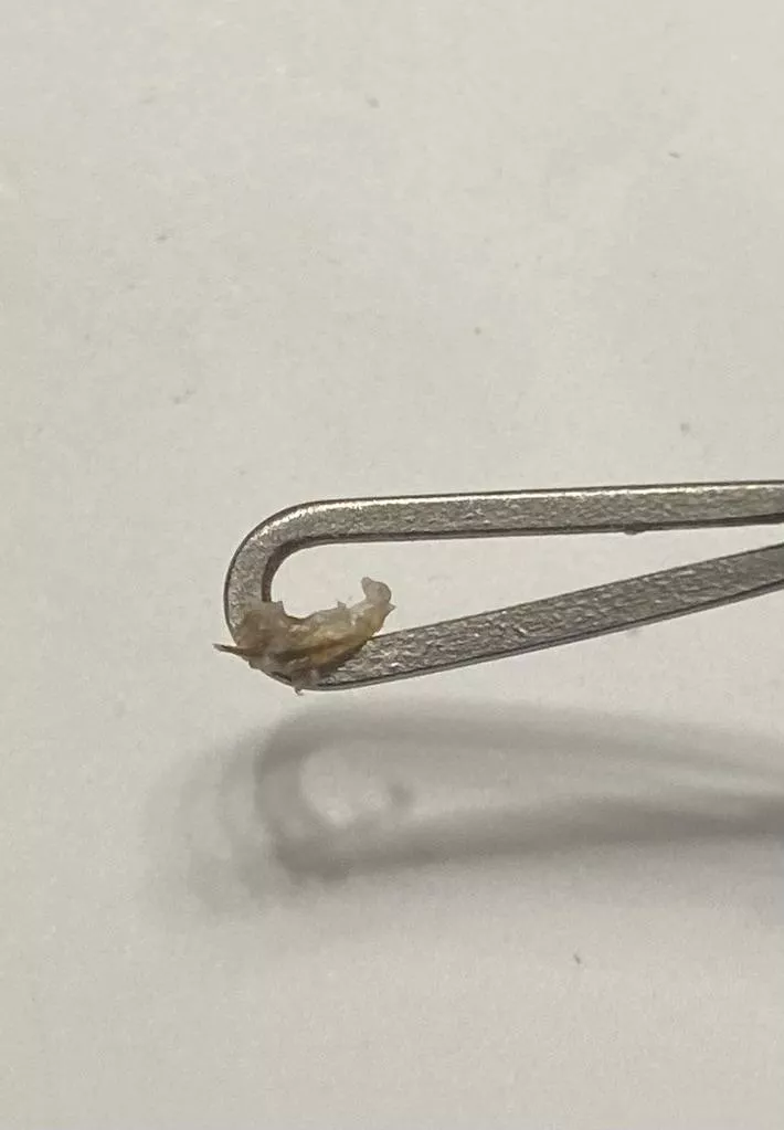 This came out of a REALLY painful bump in a stretch mark on my side. Maybe an ingrown? The whole thing was hard, so I’m not certain.