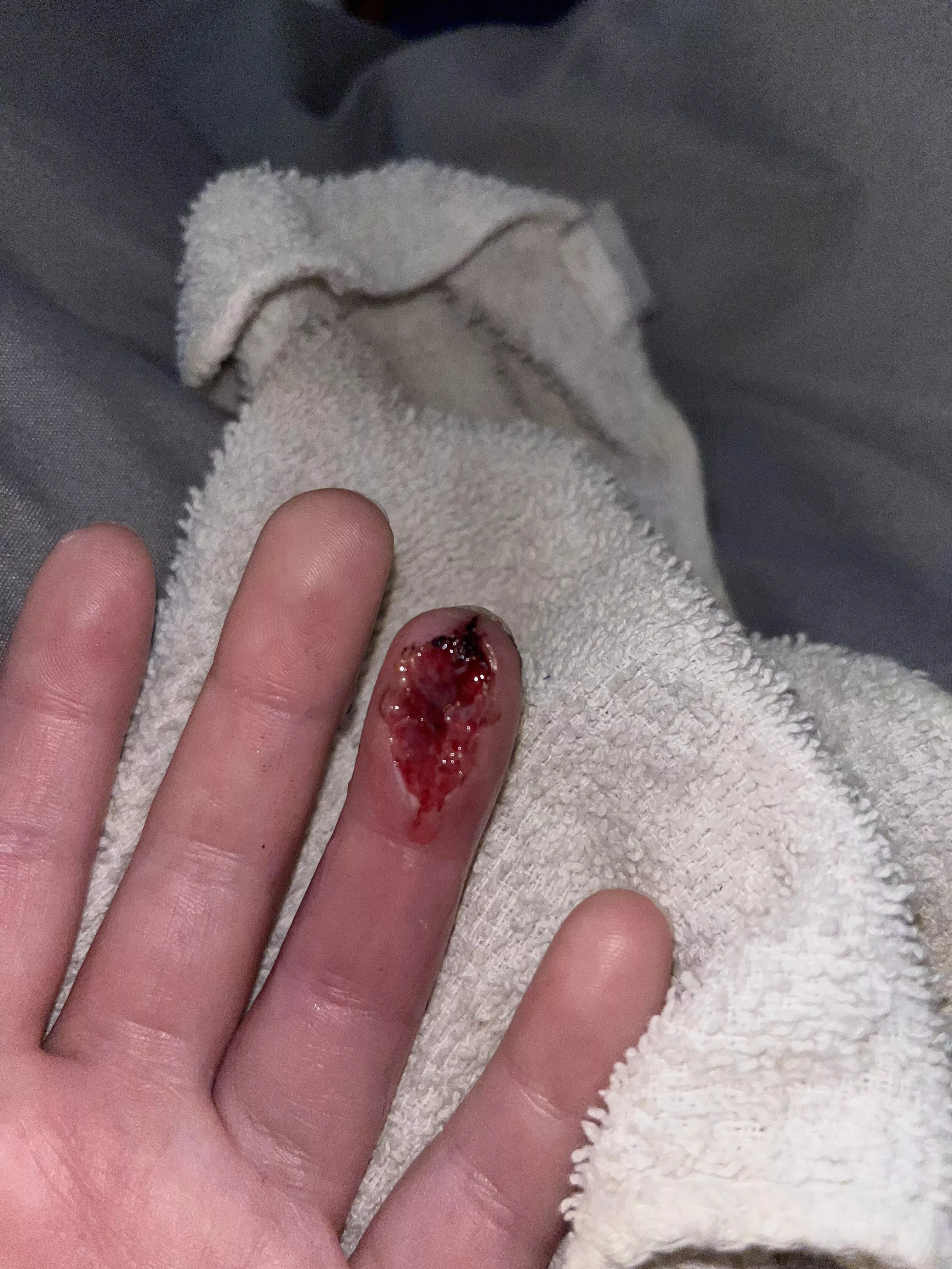 Post op day 2: looking better as more tissue grows. Only really hurts when I wash it out. Probs won’t post another update until I see the doctor again. *no I didn’t use that towel to clean it or dry it*