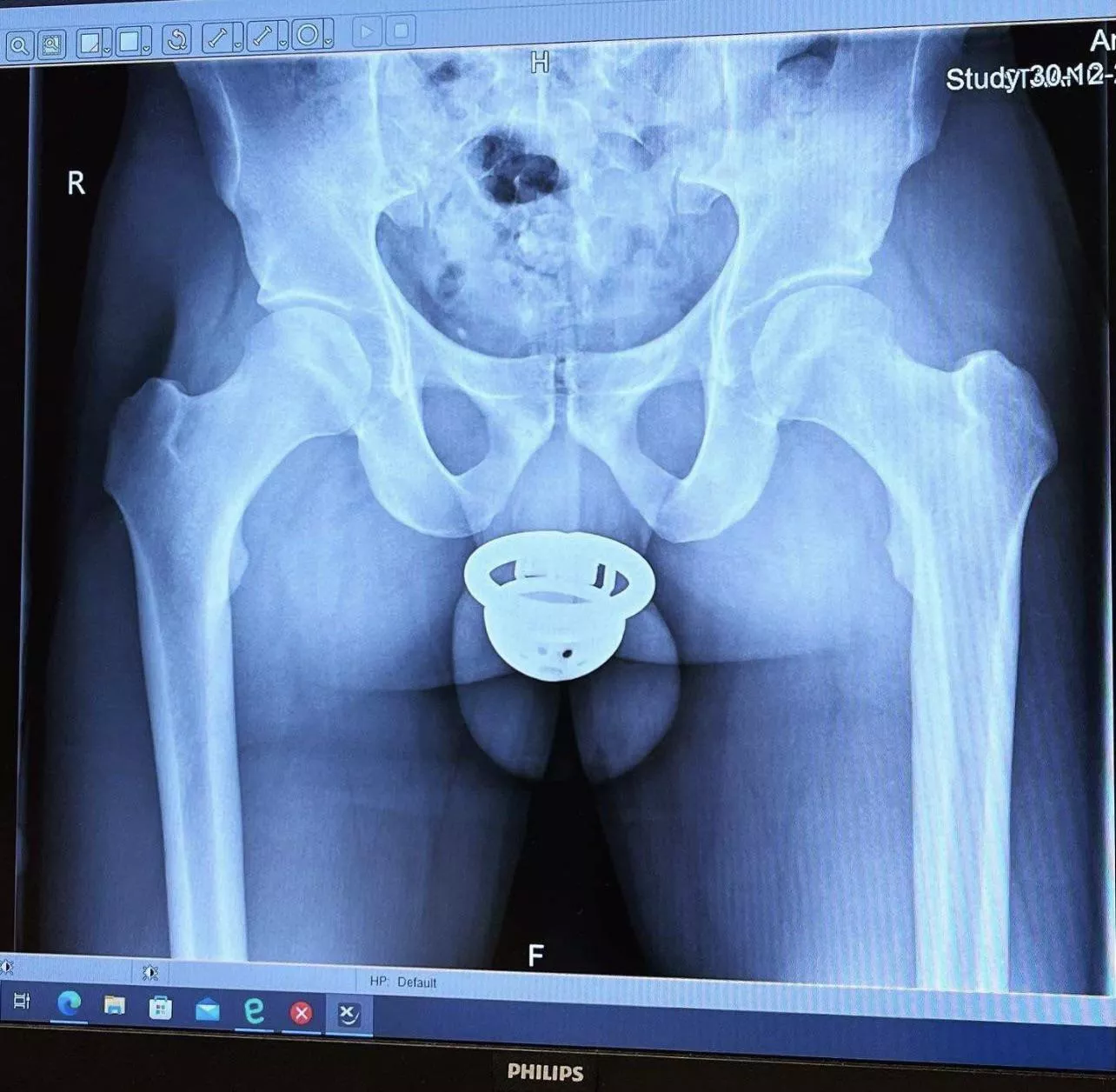 If You Ever Wondered What An X-Ray In Chastity Looks Like… (Not Me)