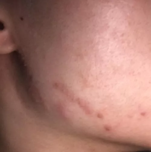 Hi, so i had eczema in December and i scratched a lot during that time. After 3-4 days, pimples began to appear around my right jaw, then they became pustules with yellow-white fluid inside (I didn’t squeeze them) and a little bit of redness and swelli