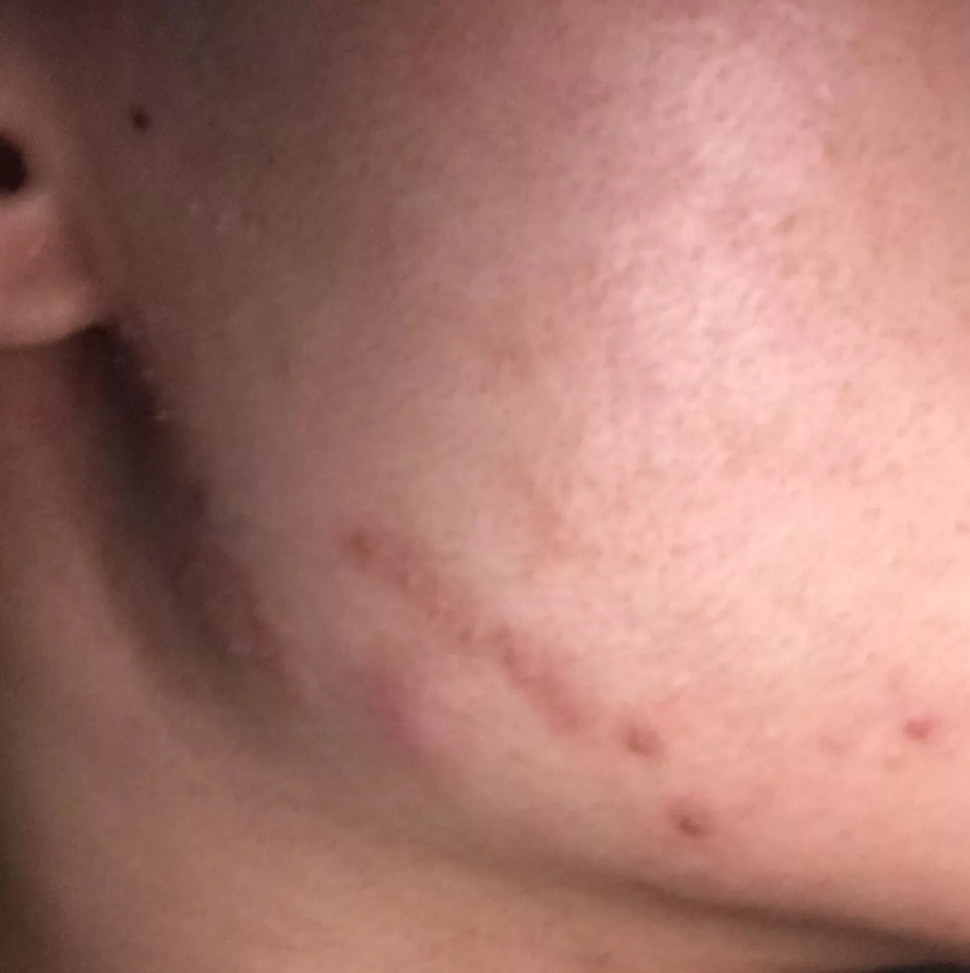 Hi, so i had eczema in December and i scratched a lot during that time. After 3-4 days, pimples began to appear around my right jaw, then they became pustules with yellow-white fluid inside (I didn’t squeeze them) and a little bit of redness and swelli