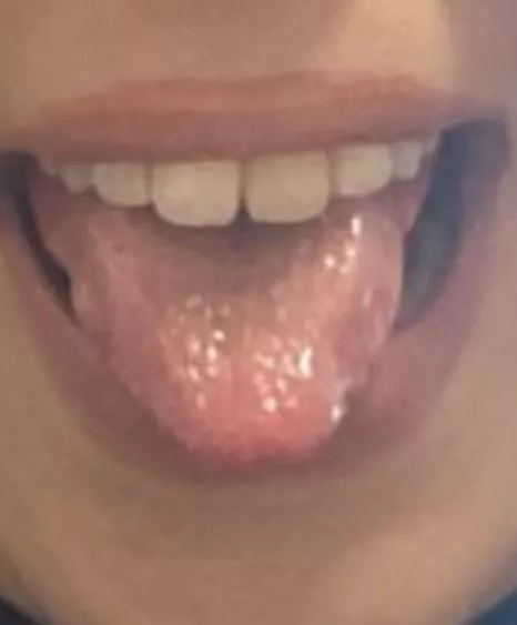 Moist tounge