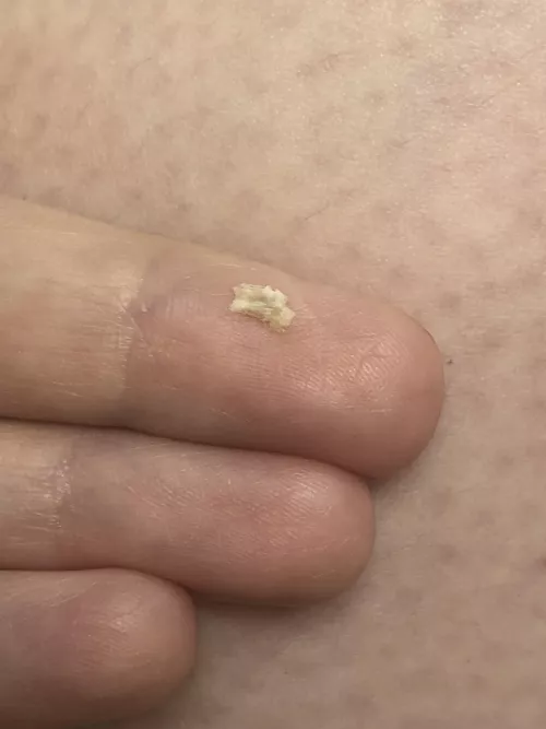 Popped this baby out of my gums this morning after wisdom tooth extraction in December