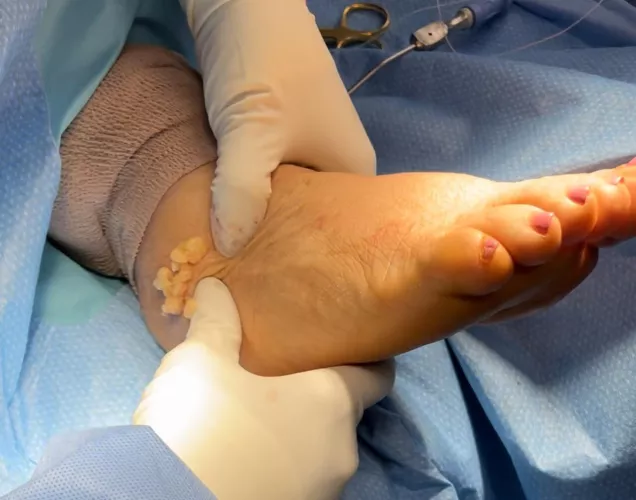 Extracting a lipoma from an ankle