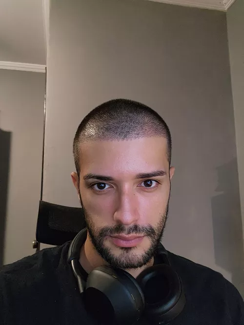 Had a hair transplant, the confidence boost I was needing.