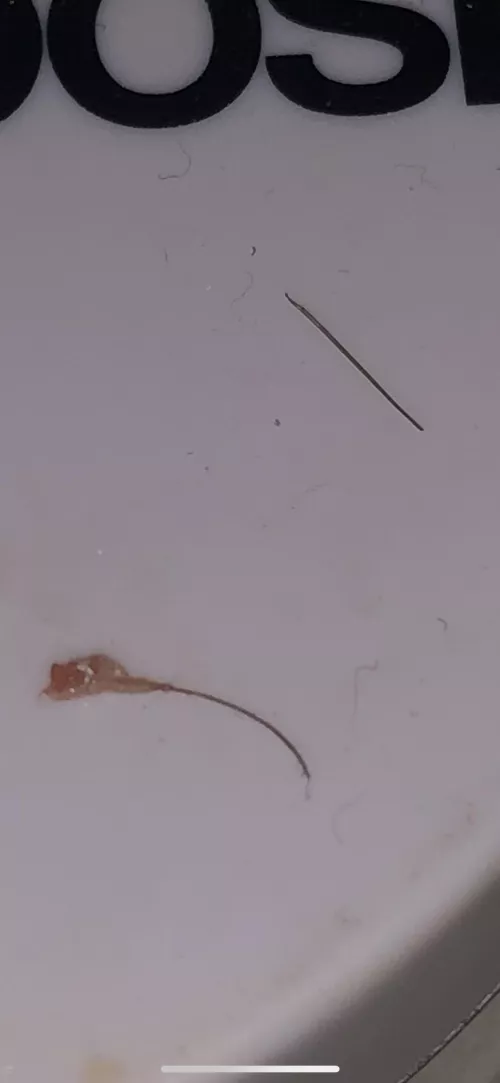Had ingrown hair bump, I squeezed it and this monster popped out (next to ‘normal’ hair. Why does it look like this?