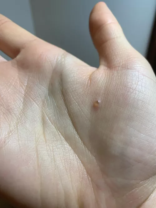 is this eczema? not sure how to treat or when it will disappear