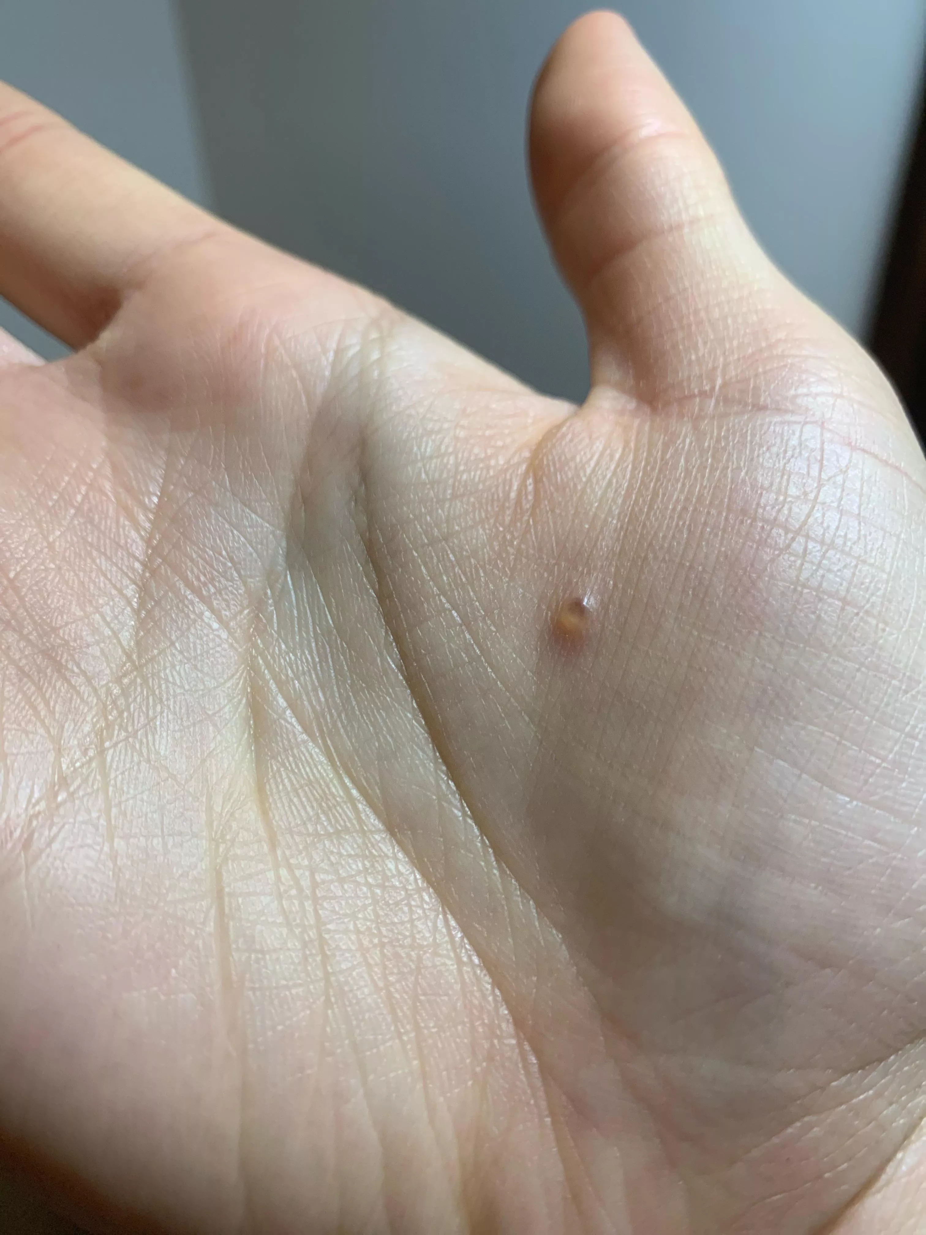 is this eczema? not sure how to treat or when it will disappear