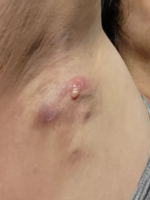 Recently diagnosed with H.S.