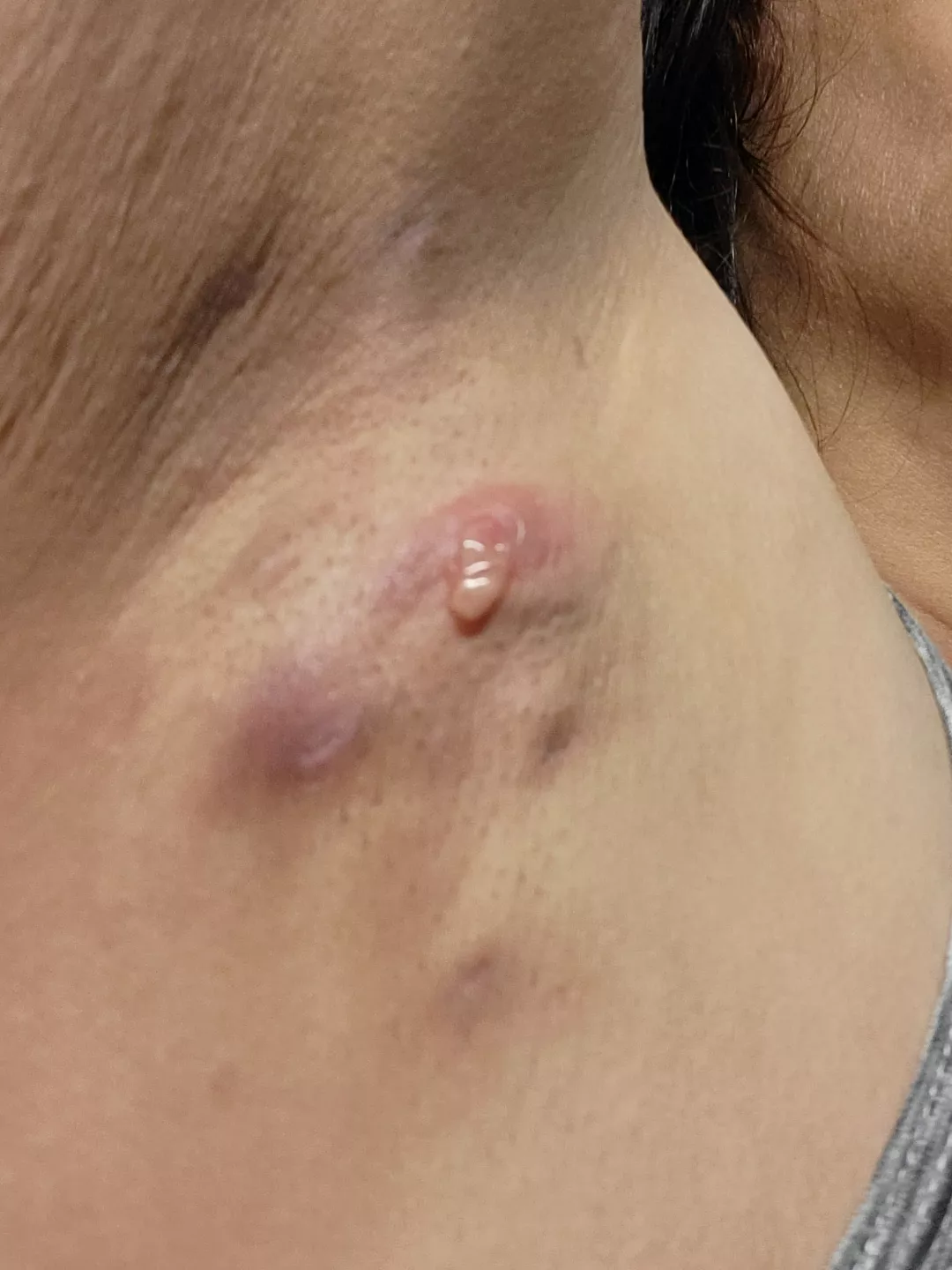 Recently diagnosed with H.S.