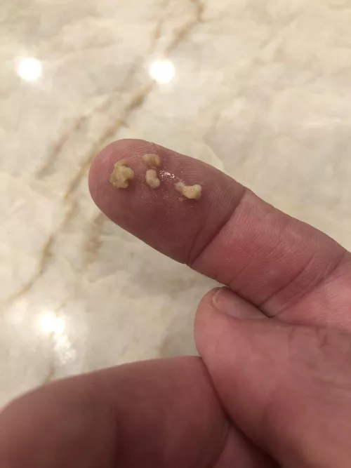 A post-Covid coughing fit just dislodged this happy family of tonsil stones.