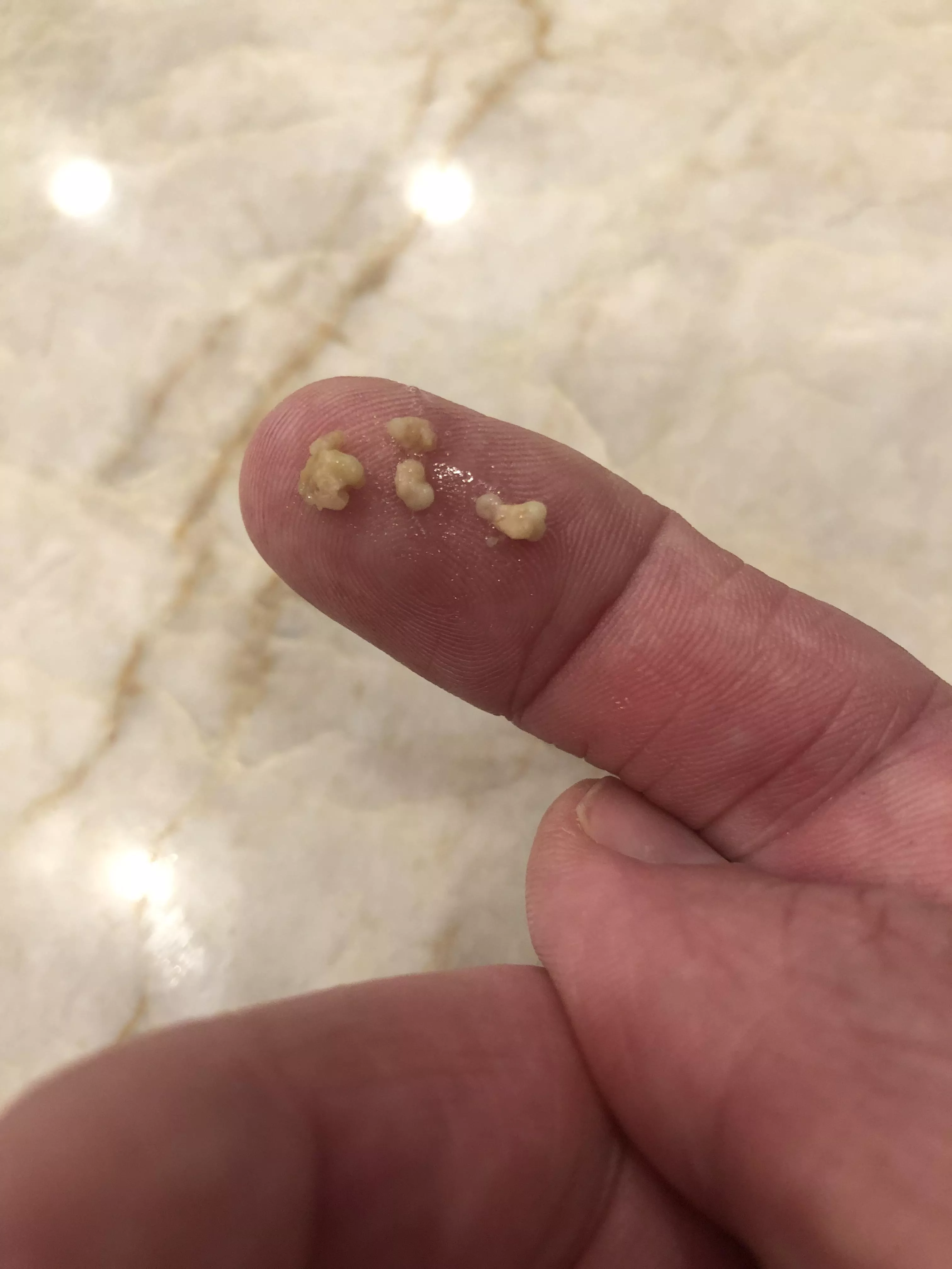 A post-Covid coughing fit just dislodged this happy family of tonsil stones.