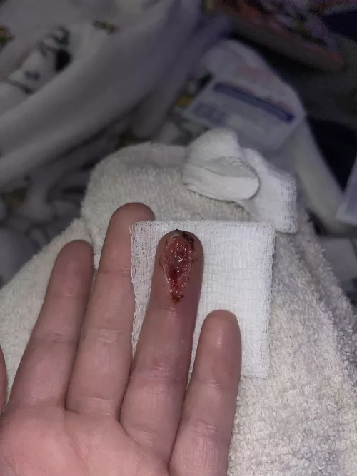 Update: Day 5 after clean out (took this last night) See my doctor Thursday instead of today due to illness (unrelated to finger)