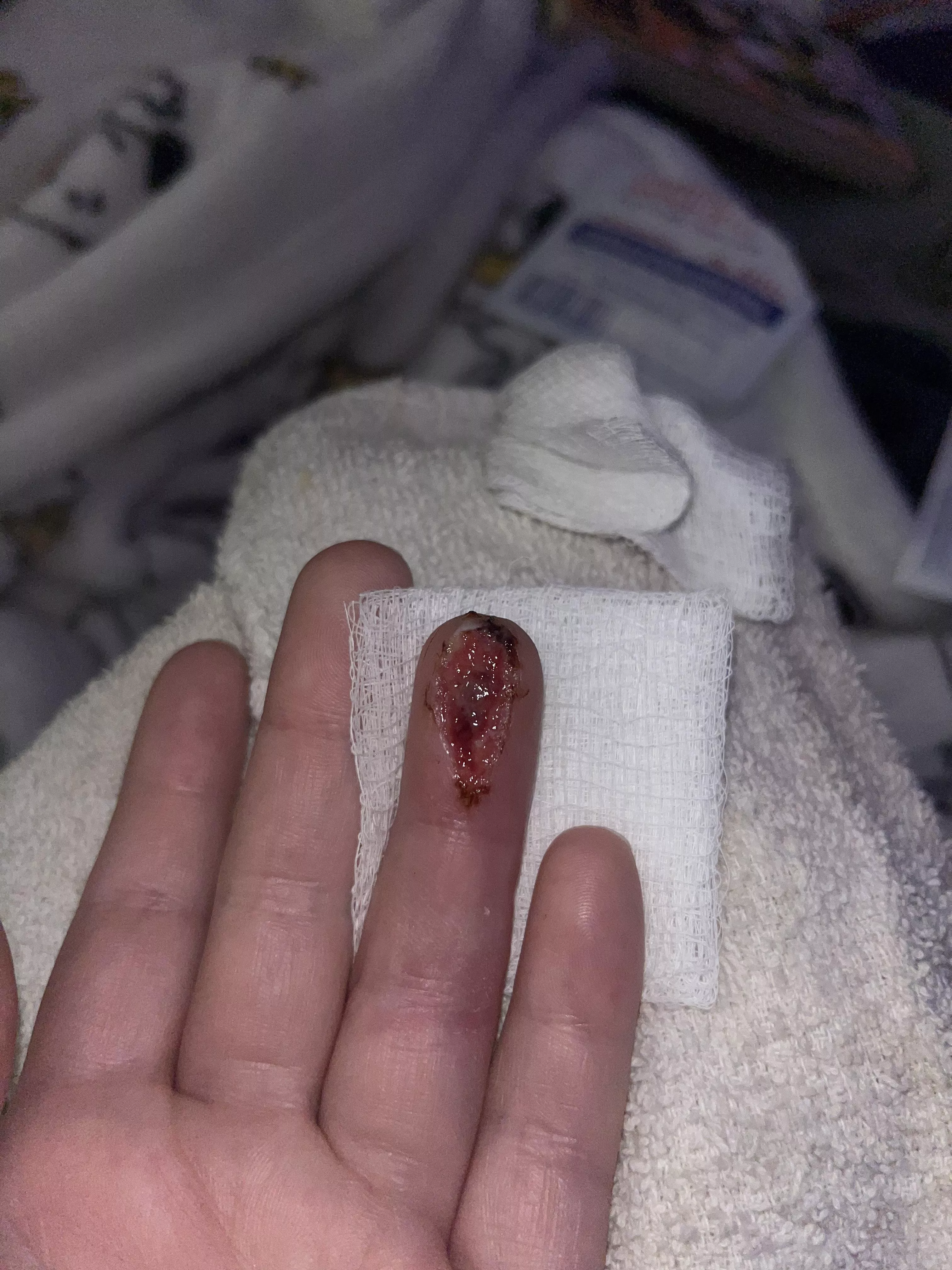 Update: Day 5 after clean out (took this last night) See my doctor Thursday instead of today due to illness (unrelated to finger)