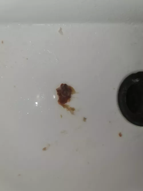 Aftermath of Nasal Polyps/Blockages