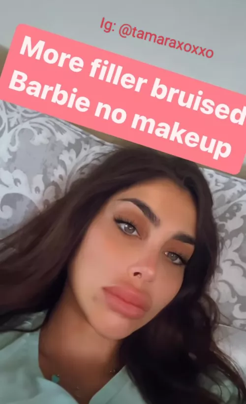 Bruising is part of the process