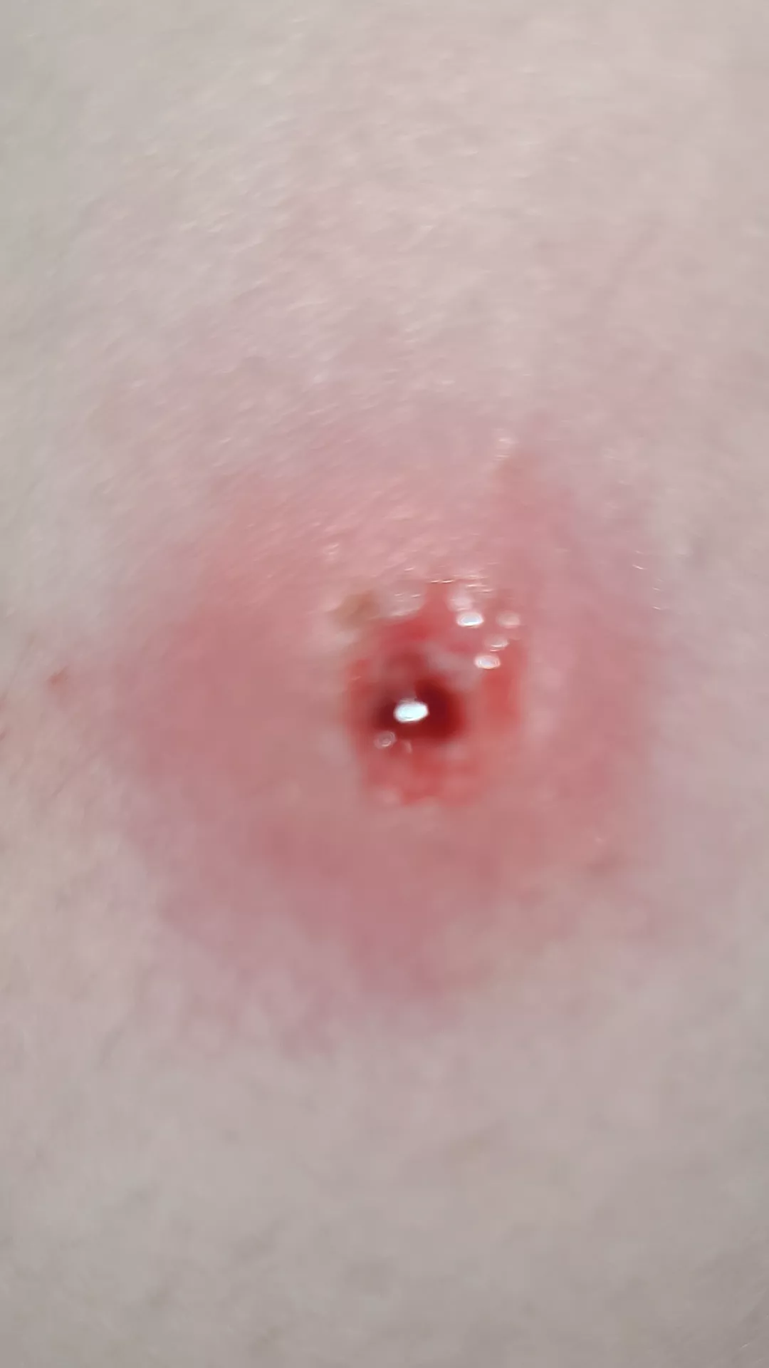 pit ob my leg after a mental break down 🫠