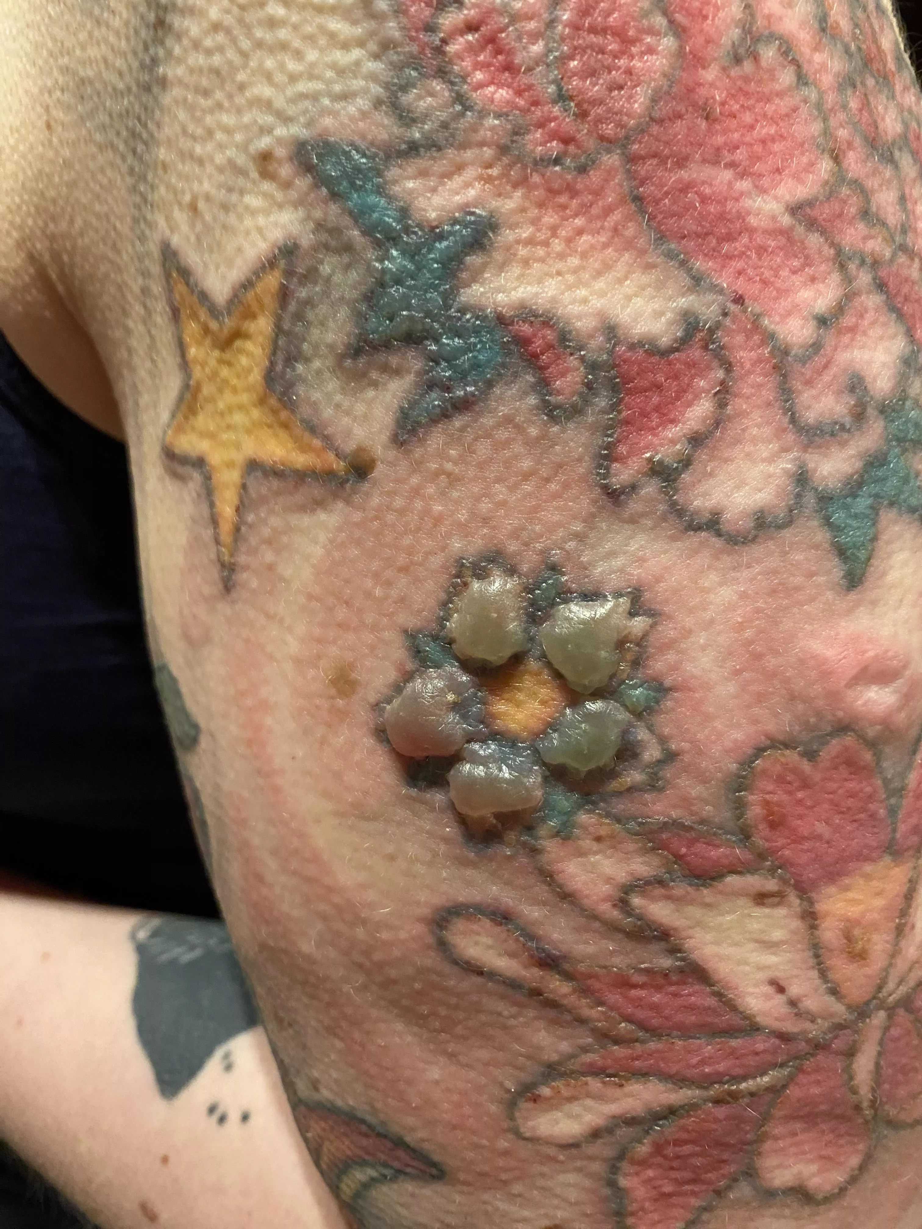 Forbidden flower pop after a session of laser tattoo removal.