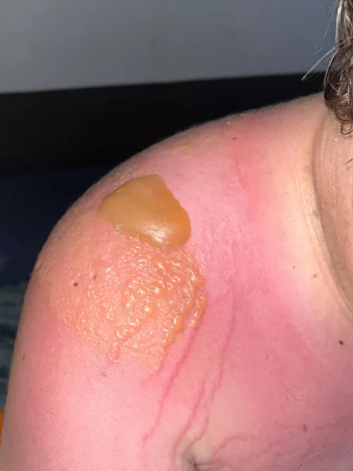 BF’s sunburn blister he won’t let me pop