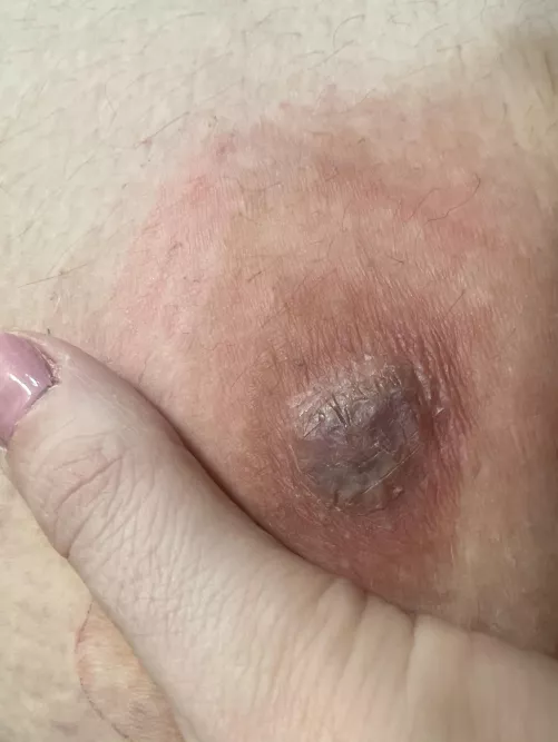 cyst? on my inner thigh- currently getting ready to head to UC in hopes they can drain it or something because it really hurts now & i’m afraid to attempt it by myself :(