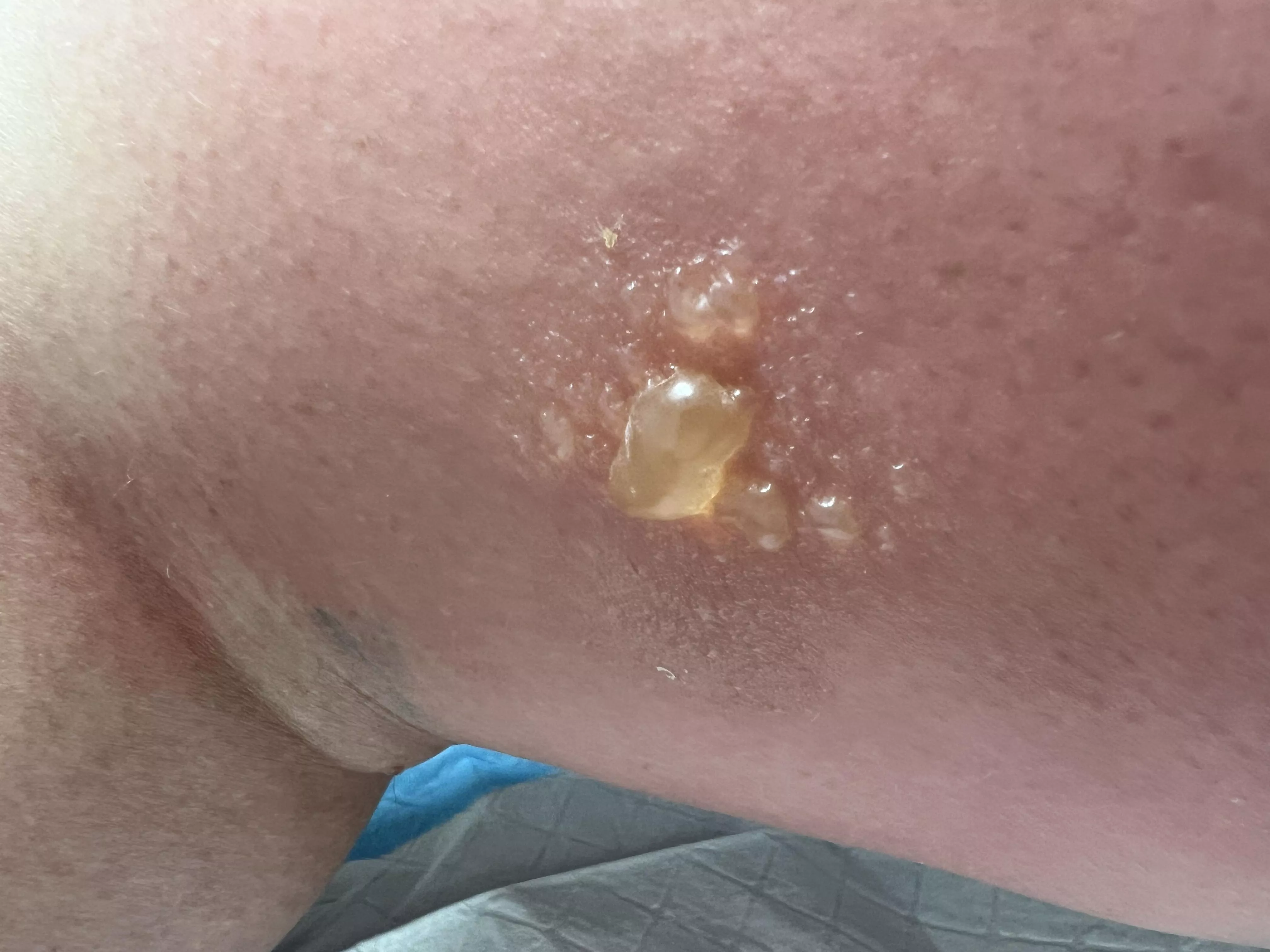 Forbidden pop - allergic reaction post bee sting 🐝 OC