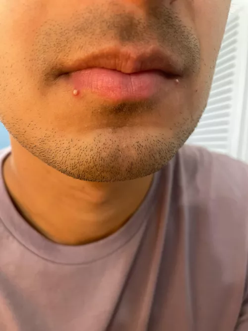 I start a new job tomorrow. It's time to pop these? I slept with one half-developed whitehead but woke up with 2!!