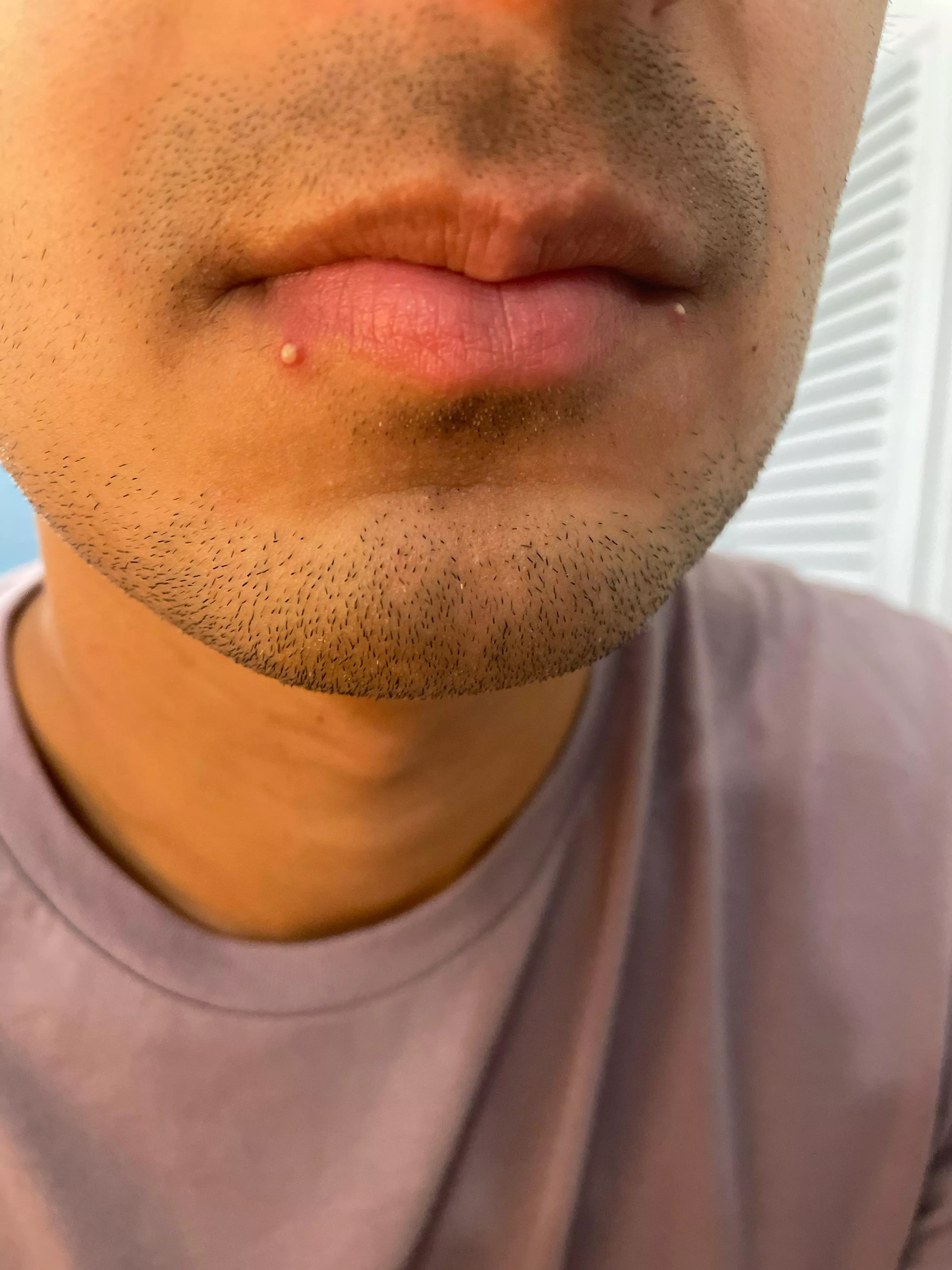 I start a new job tomorrow. It's time to pop these? I slept with one half-developed whitehead but woke up with 2!!