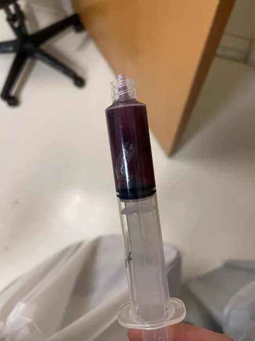 Got my Bartholin cyst drained. This is what came out 🫥