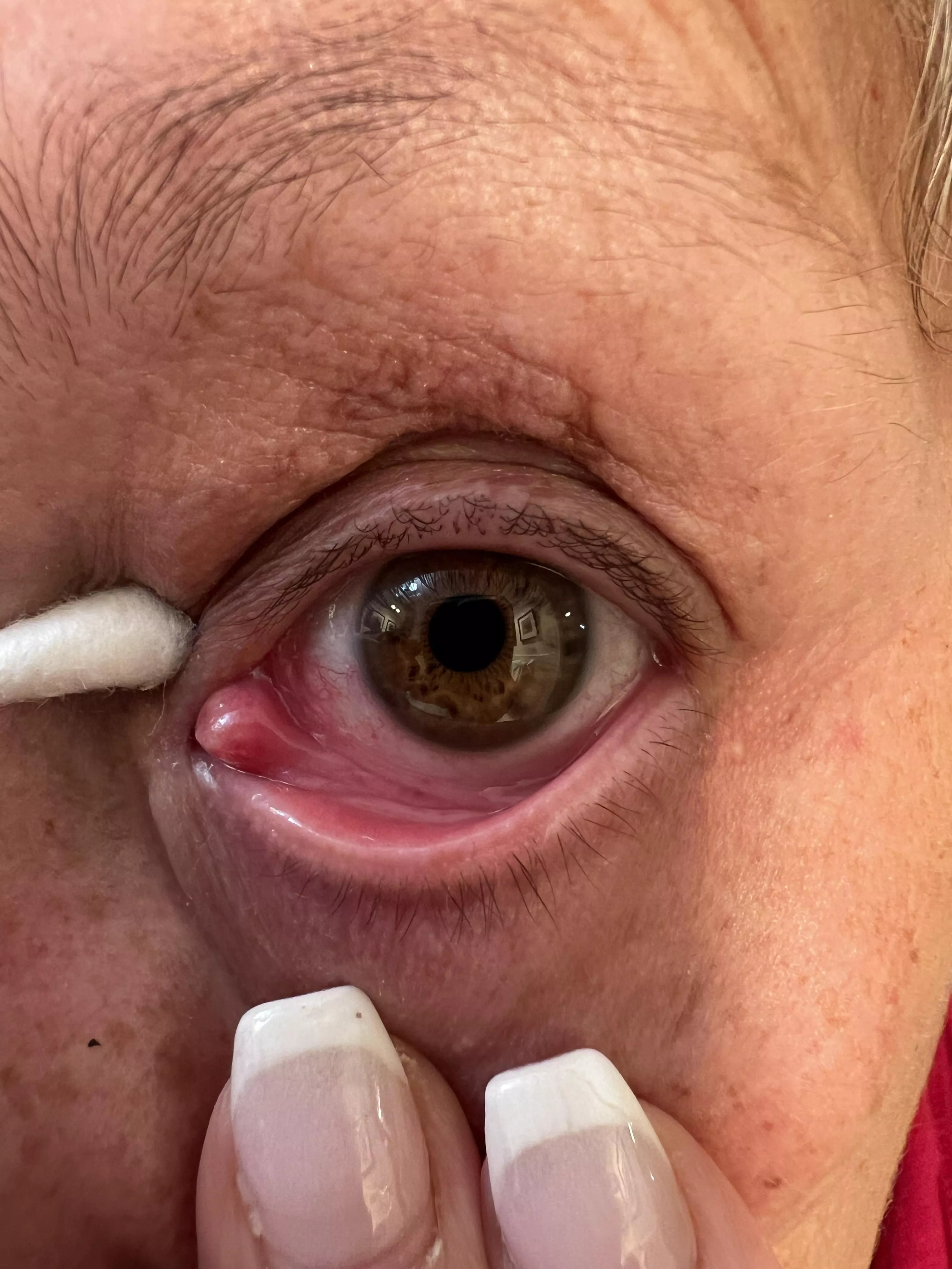 Is this a blocked tear duct?