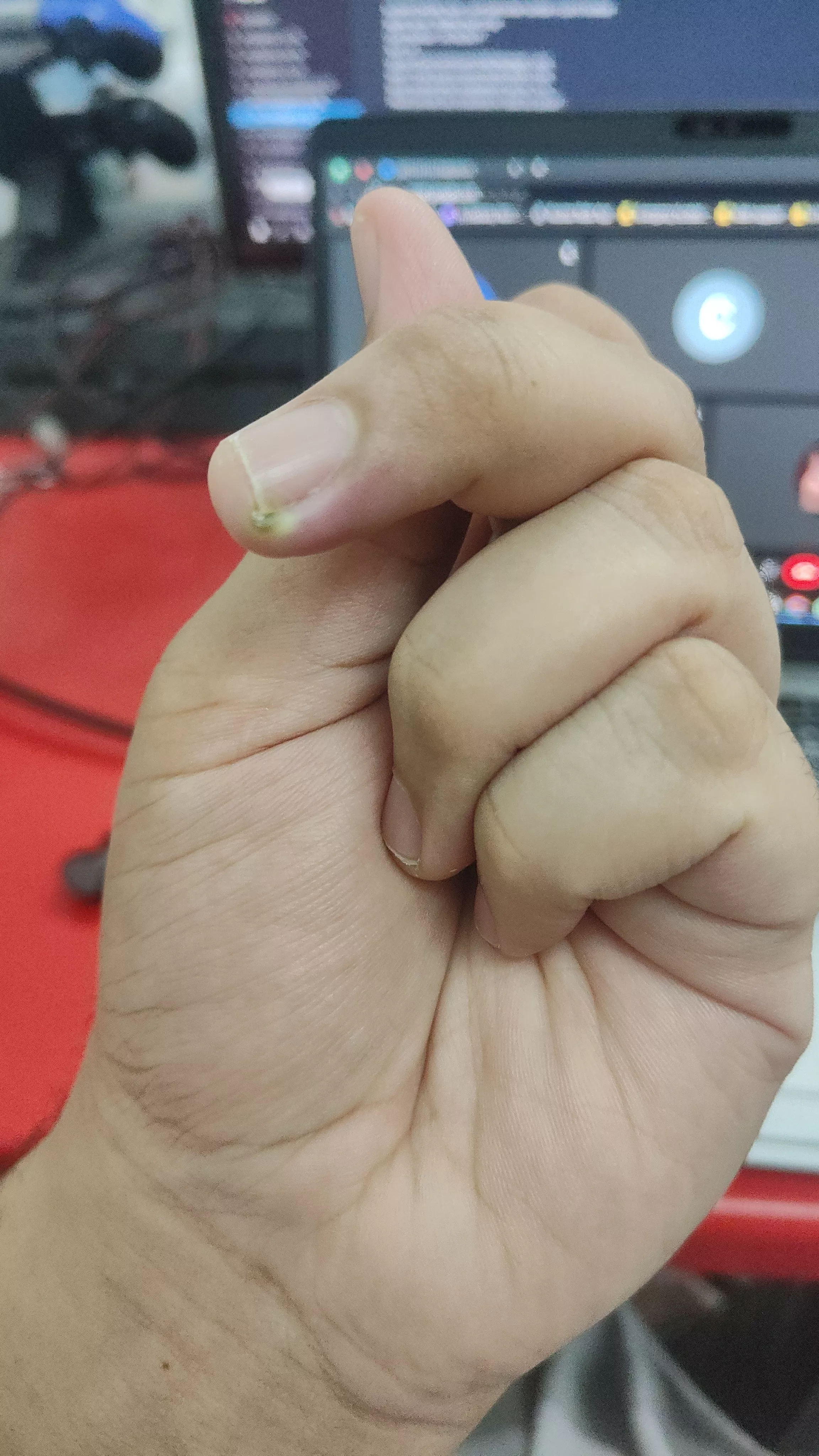 is this adenoid stone?