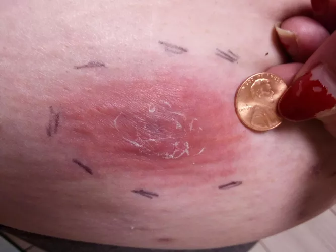 I think my abcess is gonna blow today!