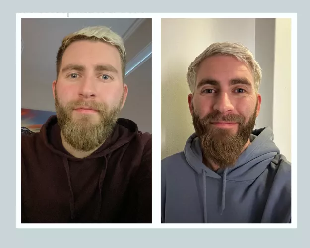 Got burnout a little over a year ago due to PTSD, depression and work stress. Just finished vocational rehab and started a promising and exciting new job last Wednesday! (Dec '21 vs Feb '23)