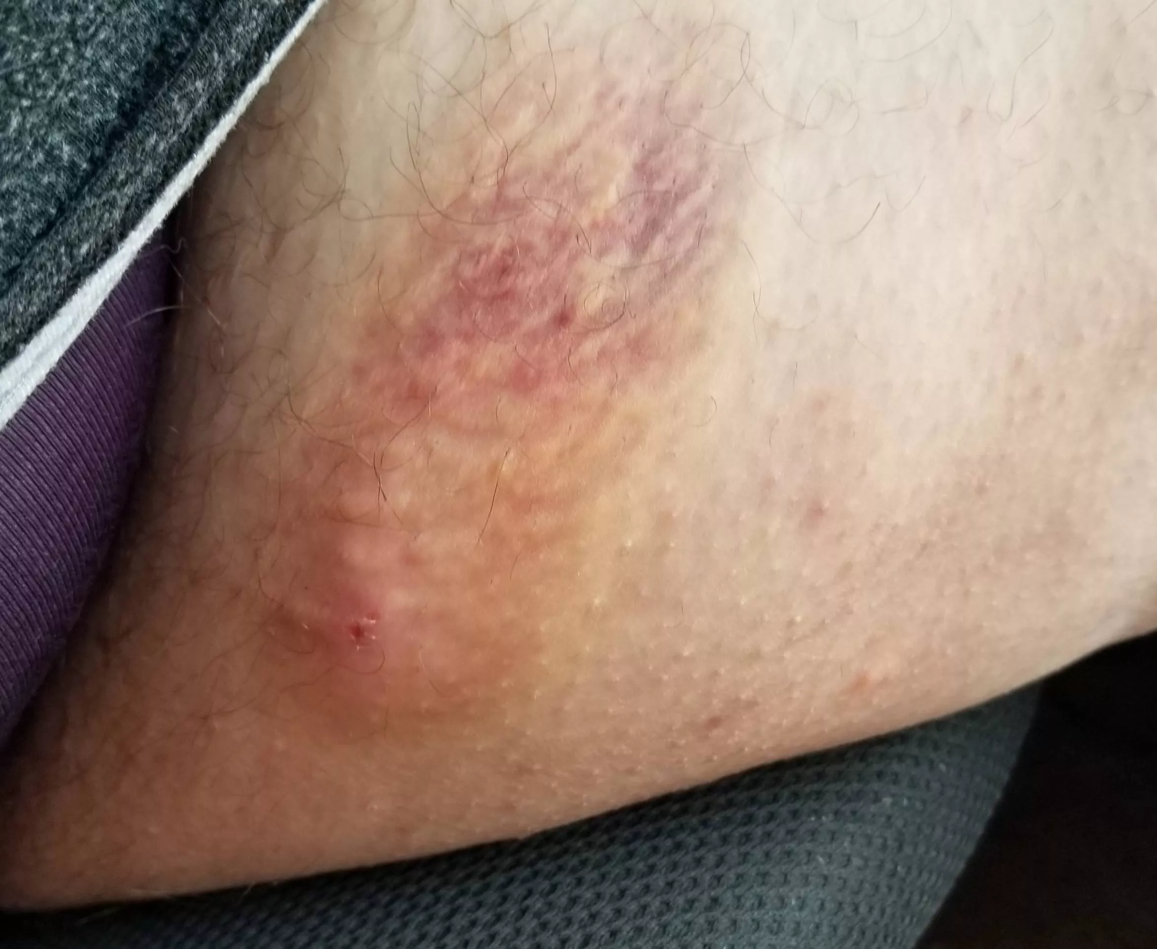 Inner thigh inflamed cyst, looking for an urgent care now