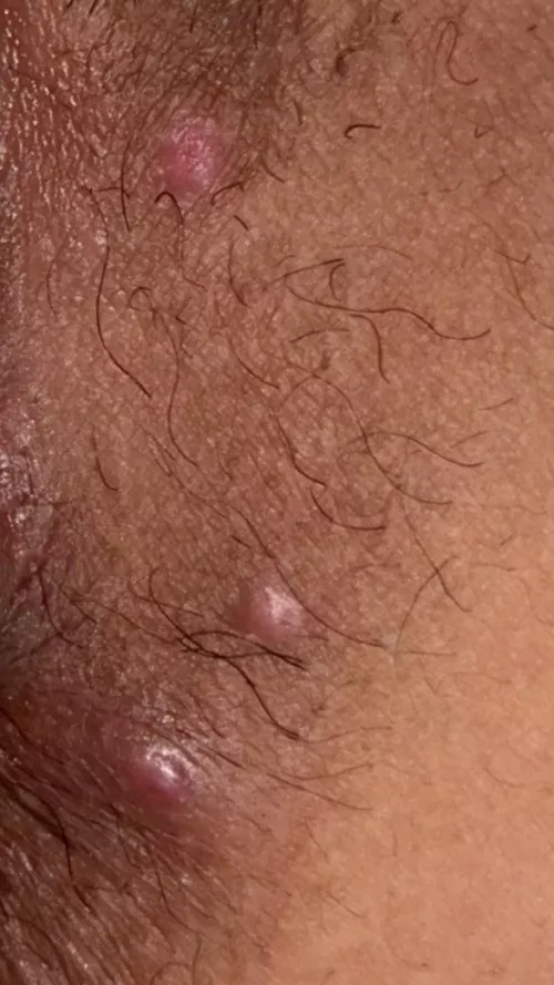could anyone help me identify what these are? I think theyre ingrown hairs but idk, the top one is closer to my vaginal opening & the other two are closer to my anus / inner buttcheek they dont hurt & have been there for almost a week now the onl