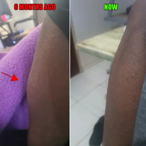 What's this lump in my left shin? It spontaneously appeared beneath the skin 6 months ago (I'm 33), the first 2 weeks it was soft, large, a bit painful and maybe mobile. Now its hard, small about the size of a marble but shaped like an egg, no pain, no