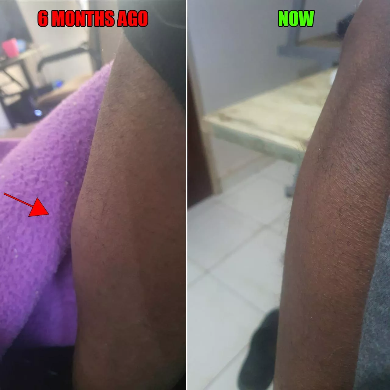 What's this lump in my left shin? It spontaneously appeared beneath the skin 6 months ago (I'm 33), the first 2 weeks it was soft, large, a bit painful and maybe mobile. Now its hard, small about the size of a marble but shaped like an egg, no pain, no What's this lump in my left shin? It spontaneously appeared beneath the skin 6 months ago (I'm 33), the first 2 weeks it was soft, large, a bit painful and maybe mobile. Now its hard, small about the size of a marble but shaped like an egg, no pain, no