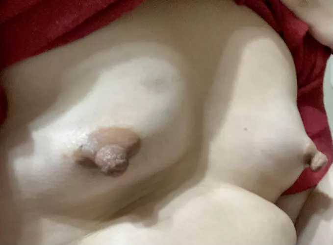 26F 106lbs 5’2’’ I used to hate what was under the shirt. But they’re unique and special to me now. What do you think?