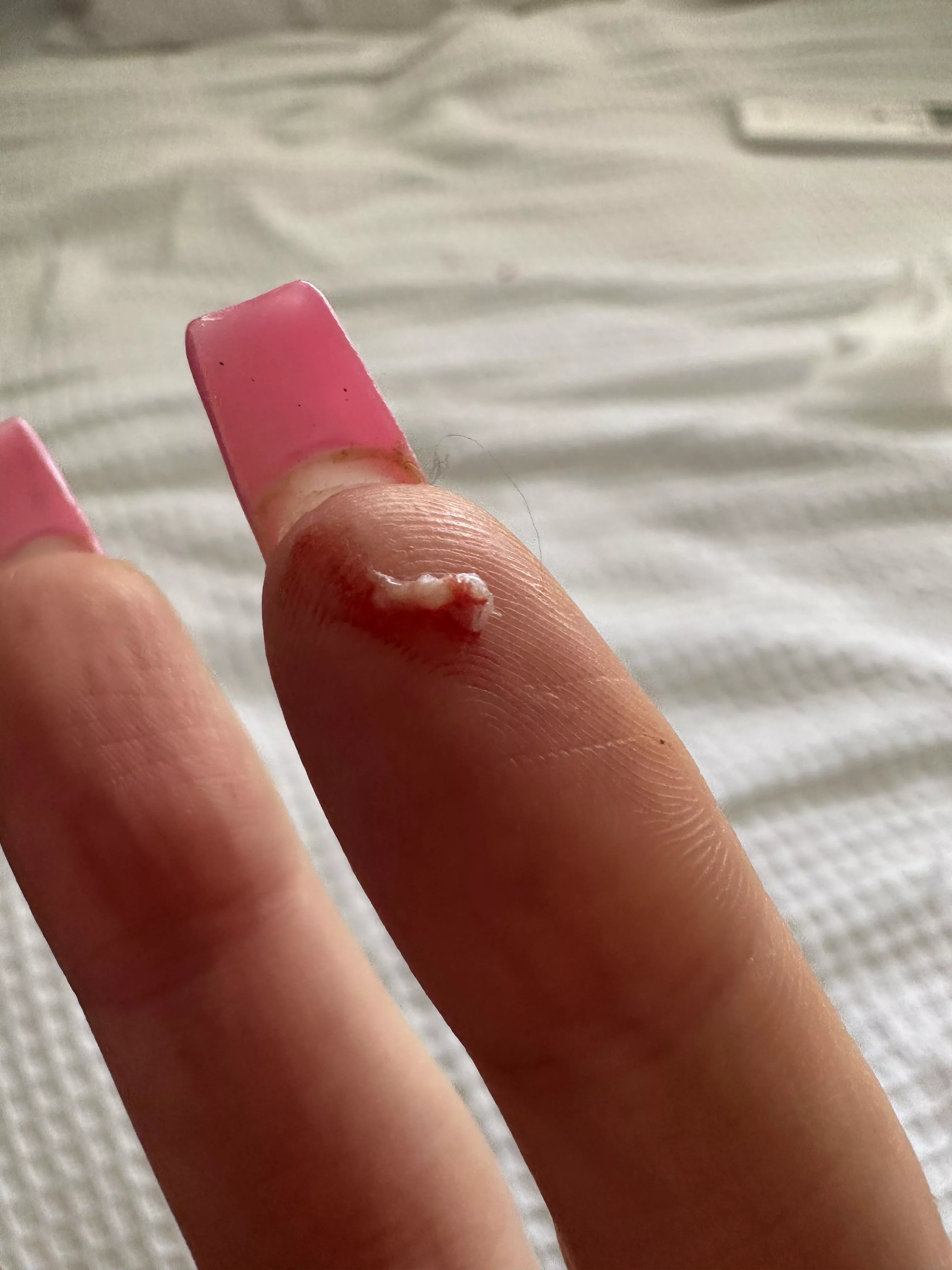 Finally popped a painful ingrown hair in my pubic region 😅 wish I got a vid!