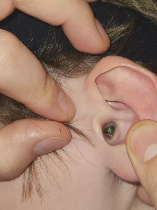 Let's try this again... My son has had a lego on his ear for 3 years...