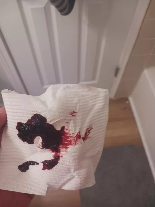 Thrombosed hemmorhoid FINALLY decided to explode. Been the BANE of my existence for the last two weeks. This was only the first squeeze, not even half of what came out. SO much blood jello!