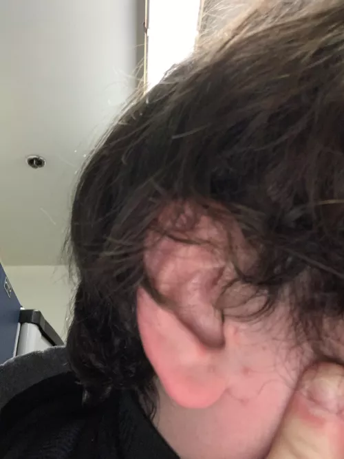 Some pops on and around my ear from having a bluetooth earbud in my ear underneath my earmuffs mounted to my hardhat at work. Not super fun