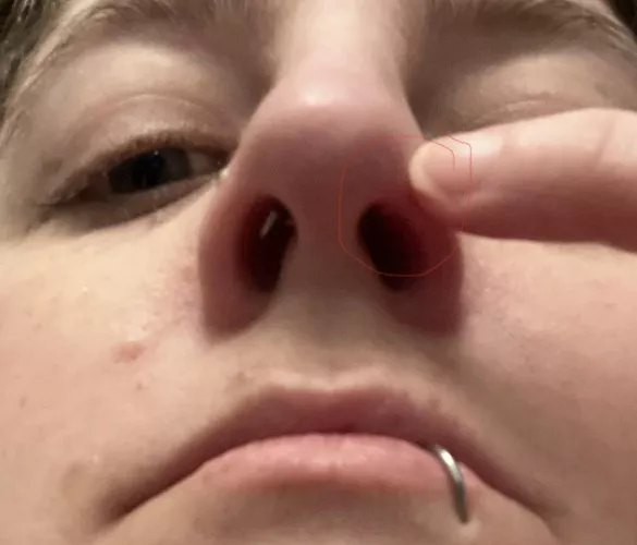 Forbidden Pimple Placement